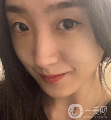 吉大一院整形外科價(jià)格表明細(xì)公布，隆鼻紀(jì)實(shí)案例分享