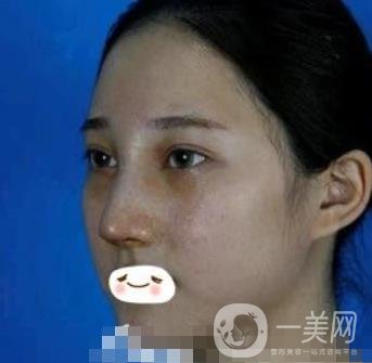 廣州禾麗醫(yī)院做雙眼皮怎么樣?看*果圖和價格表