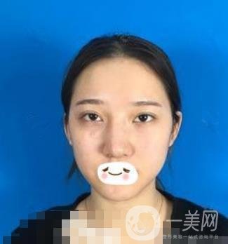 廣州禾麗醫(yī)院做雙眼皮怎么樣?看*果圖和價格表