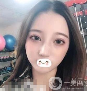 廣州禾麗醫(yī)院做雙眼皮怎么樣?看*果圖和價格表