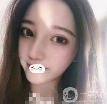 廣州禾麗醫(yī)院做雙眼皮怎么樣?看*果圖和價格表