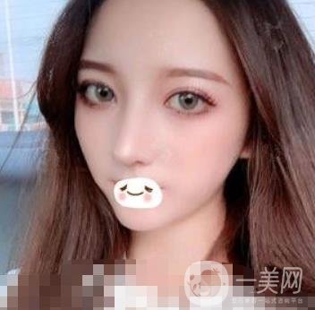 廣州禾麗醫(yī)院做雙眼皮怎么樣?看*果圖和價格表