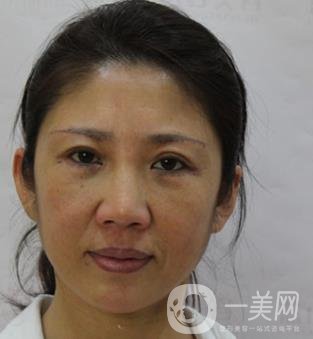 安徽醫(yī)科大學(xué)第(一)附屬醫(yī)院整形外科價格表，附去眼袋案例