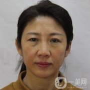 安徽醫(yī)科大學第(一)附屬醫(yī)院整形外科價格表，附去眼袋案例