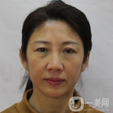 安徽醫(yī)科大學(xué)第(一)附屬醫(yī)院整形外科價格表，附去眼袋案例