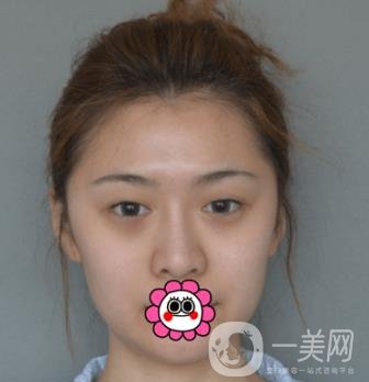 延吉金光善整形美容醫(yī)院價格表收費明細_雙眼皮手術(shù)真人體驗分享