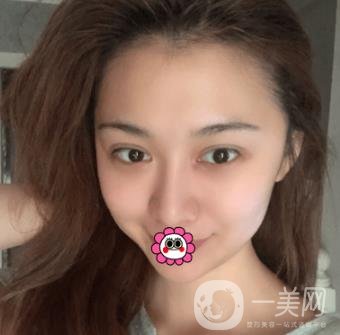 延吉金光善整形美容醫(yī)院價格表收費明細_雙眼皮手術(shù)真人體驗分享