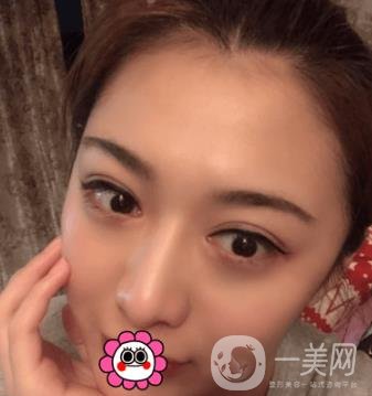 延吉金光善整形美容醫(yī)院價格表收費明細_雙眼皮手術(shù)真人體驗分享