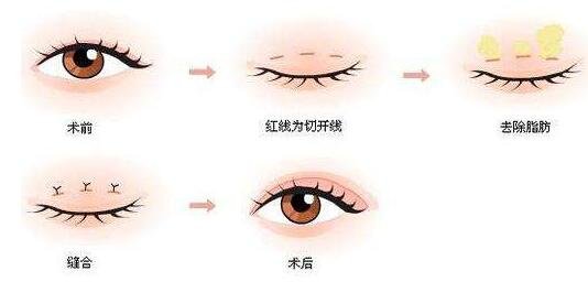三點(diǎn)雙眼皮能維持幾年?
