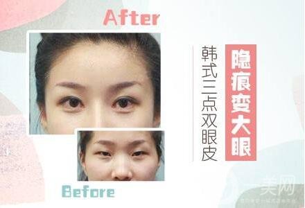 三點(diǎn)雙眼皮能維持幾年?