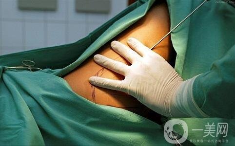 關(guān)于吸脂手術(shù)的流程與*性，你都知道嗎？