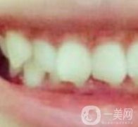 張家港澳洋醫(yī)院整牙怎么樣？牙齒矯正價格及經(jīng)歷分享