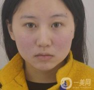 武漢市第一醫(yī)院*多少錢？美容科案例精選