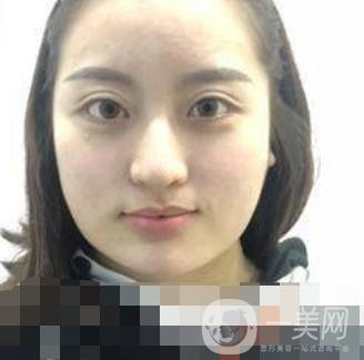 河北省人民醫(yī)院整形外科價(jià)格表新版來(lái)襲，附去下頜骨案例