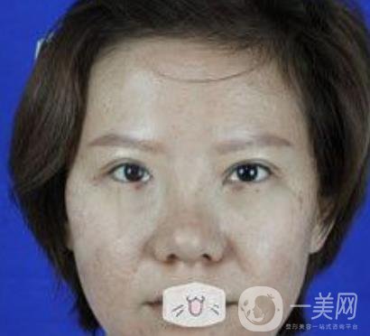 綿陽中心醫(yī)院整形美容科價格表2020發(fā)布，附祛眼袋案例