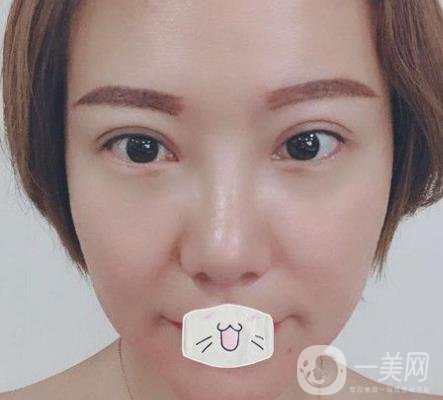 綿陽中心醫(yī)院整形美容科價格表2020發(fā)布，附祛眼袋案例