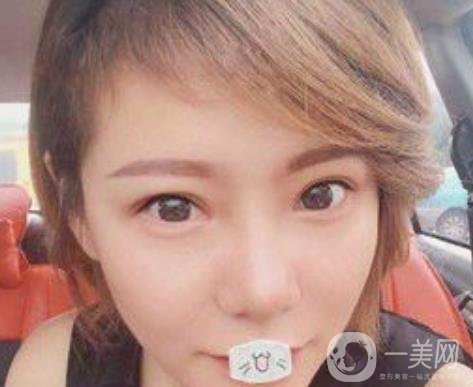 綿陽中心醫(yī)院整形美容科價格表2020發(fā)布，附祛眼袋案例