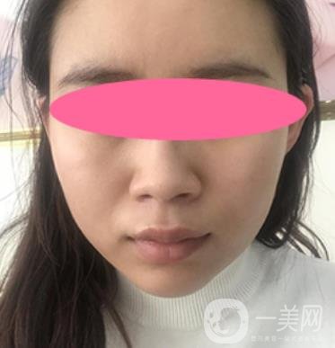 寧波第一醫(yī)院整形科價(jià)格表收費(fèi)明細(xì)上線，看打玻尿酸真人案例