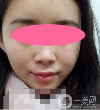 寧波第一醫(yī)院整形科價(jià)格表收費(fèi)明細(xì)上線，看打玻尿酸真人案例