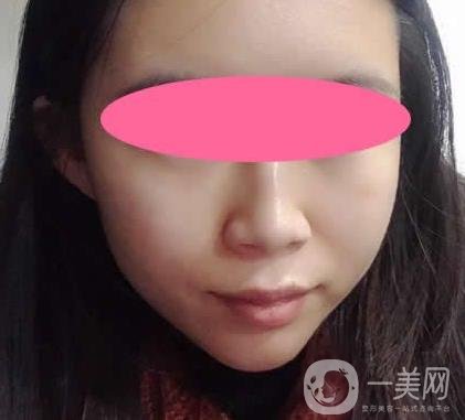 寧波第一醫(yī)院整形科價(jià)格表收費(fèi)明細(xì)上線，看打玻尿酸真人案例