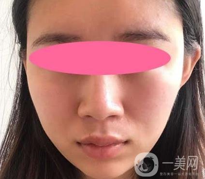 寧波第一醫(yī)院整形科價(jià)格表收費(fèi)明細(xì)上線，看打玻尿酸真人案例