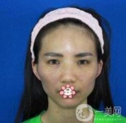 上海第九人民醫(yī)院整形外科價格表，附面部脂肪填充案例