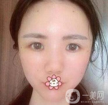 上海第九人民醫(yī)院整形外科價格表，附面部脂肪填充案例