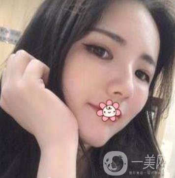 上海第九人民醫(yī)院整形外科價格表，附面部脂肪填充案例