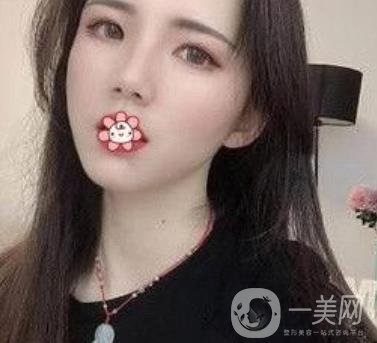 上海第九人民醫(yī)院整形外科價格表，附面部脂肪填充案例