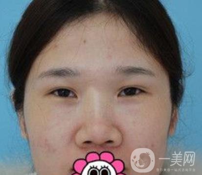 2020北京大學(xué)深圳醫(yī)院整形科價(jià)格表，附雙眼皮案例
