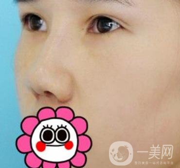 2020北京大學(xué)深圳醫(yī)院整形科價(jià)格表，附雙眼皮案例