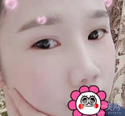 2020北京大學(xué)深圳醫(yī)院整形科價(jià)格表，附雙眼皮案例