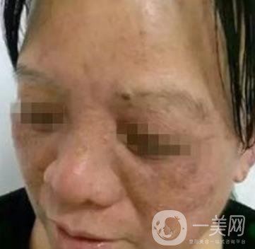 廣東省人民醫(yī)院整形科價格表，附祛斑整形日記