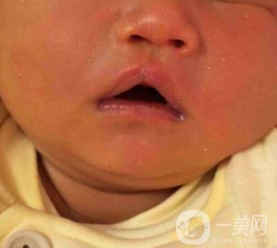 昆明醫(yī)科大學(xué)第一附屬醫(yī)院整形科價(jià)格表，內(nèi)附兔唇矯正案例