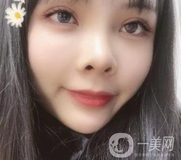 西安交通大學(xué)附屬醫(yī)院整形美容科價(jià)格表和雙眼皮案例一覽