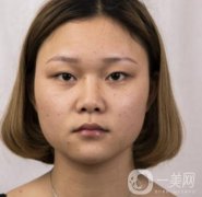 西安市中心醫(yī)院整形科價格表，內(nèi)附韓悅雙眼皮真人案例
