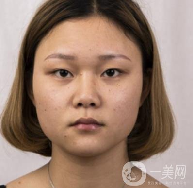 西安市中心醫(yī)院整形科價格表，內(nèi)附韓悅雙眼皮真人案例