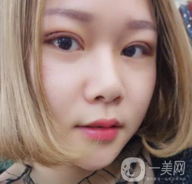 西安市中心醫(yī)院整形科價格表，內(nèi)附韓悅雙眼皮真人案例