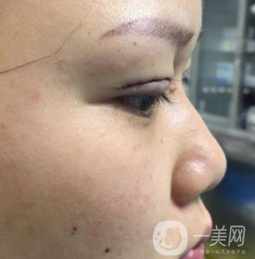 西安市中心醫(yī)院整形科價格表，內(nèi)附韓悅雙眼皮真人案例
