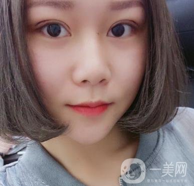 西安市中心醫(yī)院整形科價格表，內(nèi)附韓悅雙眼皮真人案例