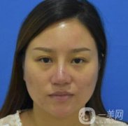 張掖市人民醫(yī)院美容整形科價格表，附眼袋切除果圖