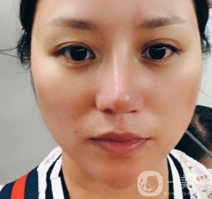 張掖市人民醫(yī)院美容整形科價格表，附眼袋切除*果圖
