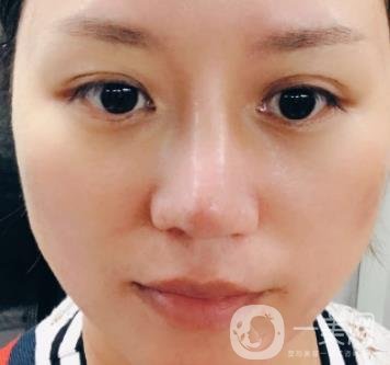 張掖市人民醫(yī)院美容整形科價格表，附眼袋切除*果圖