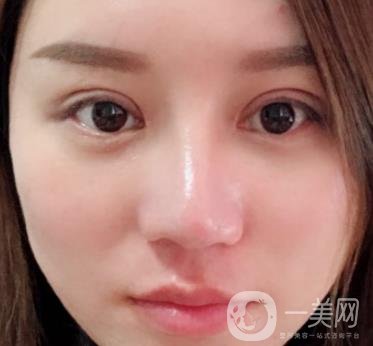 張掖市人民醫(yī)院美容整形科價格表，附眼袋切除*果圖