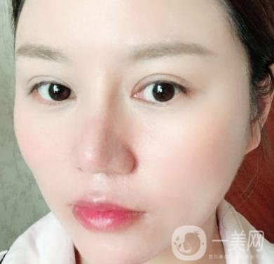 張掖市人民醫(yī)院美容整形科價格表，附眼袋切除*果圖