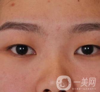 北京醫(yī)院整形項(xiàng)目2020年價(jià)格表一覽，內(nèi)附錢文江開(kāi)眼角案例