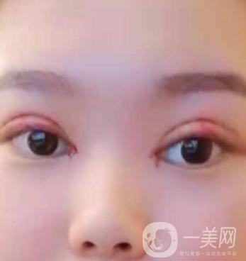 北京醫(yī)院整形項(xiàng)目2020年價(jià)格表一覽，內(nèi)附錢文江開(kāi)眼角案例