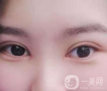 北京醫(yī)院整形項(xiàng)目2020年價(jià)格表一覽，內(nèi)附錢文江開(kāi)眼角案例