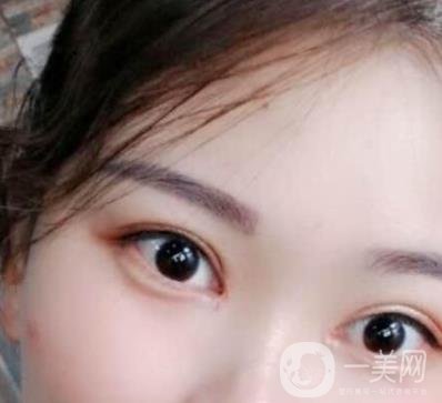 北京醫(yī)院整形項(xiàng)目2020年價(jià)格表一覽，內(nèi)附錢文江開(kāi)眼角案例