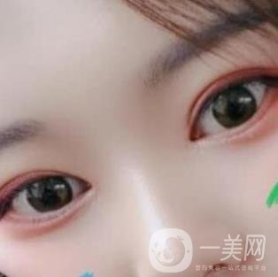 北京醫(yī)院整形項(xiàng)目2020年價(jià)格表一覽，內(nèi)附錢文江開(kāi)眼角案例